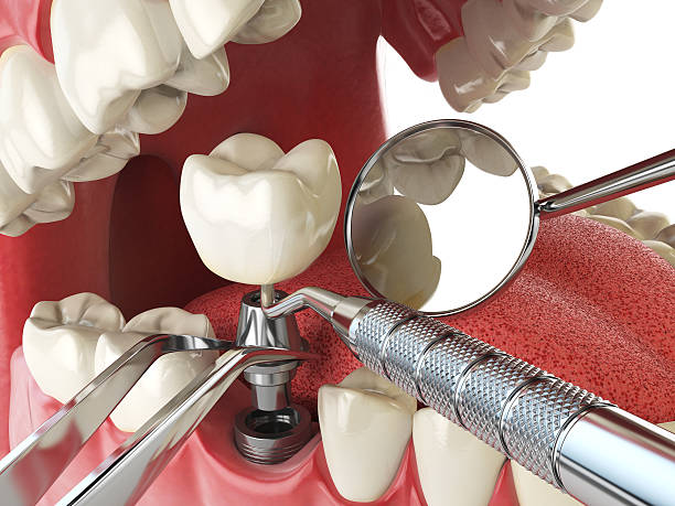 Best Broken or Chipped Tooth Repair in Beeville, TX